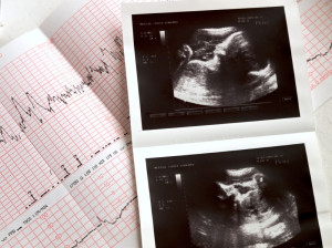 What are the risks to a pregnancy and a developing baby for mothers with PCOS?